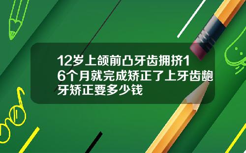 12岁上颌前凸牙齿拥挤16个月就完成矫正了上牙齿龅牙矫正要多少钱