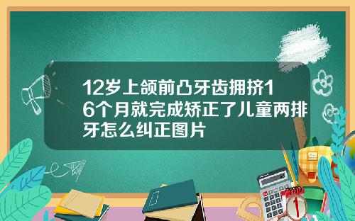 12岁上颌前凸牙齿拥挤16个月就完成矫正了儿童两排牙怎么纠正图片